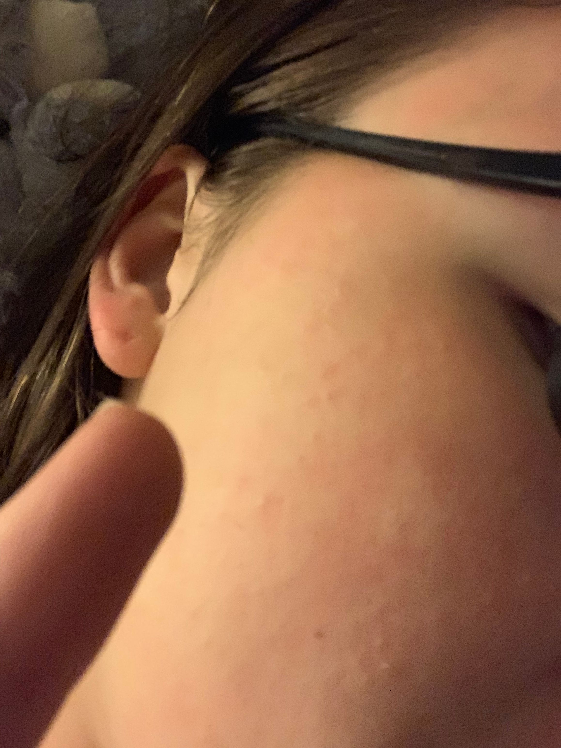 Small Bumps All Over My Face Beauty Insider Community