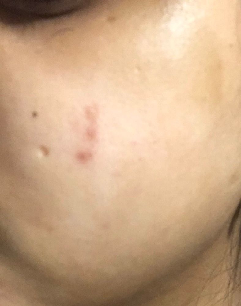 How to treat Acne scars - Beauty Insider Community